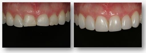 Dental Bonding - Before and After at Preventive Dentistry Braddon
